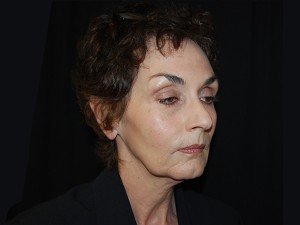 Facelift Before & After Patient #23533