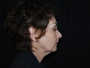 Facelift Before & After Patient #23533