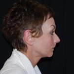 Facelift Before & After Patient #23533