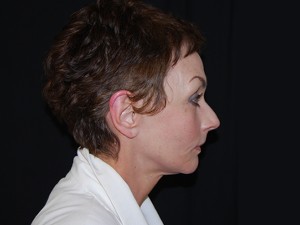 Facelift Before & After Patient #23533