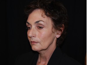 Facelift Before & After Patient #23533