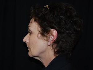 Facelift Before & After Patient #23533