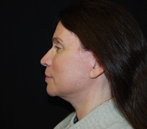 Facelift Before & After Patient #23534