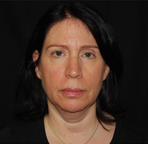 Facelift Before & After Patient #23534