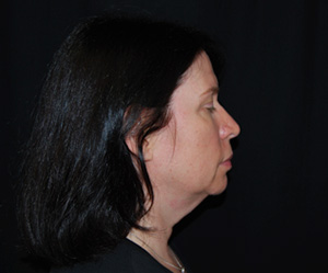 Facelift Before & After Patient #23534