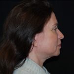 Facelift Before & After Patient #23534