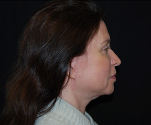 Facelift Before & After Patient #23534