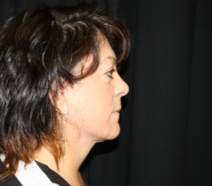 Facelift Before & After Patient #23555