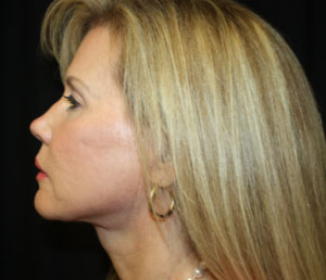 Facelift Before & After Patient #23474