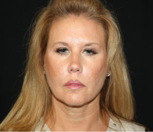 Facelift Before & After Patient #23474