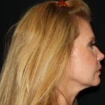 Facelift Before & After Patient #23474