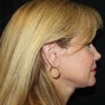 Facelift Before & After Patient #23474