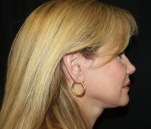 Facelift Before & After Patient #23474