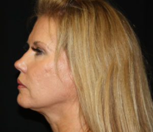 Facelift Before & After Patient #23474