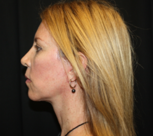 Facelift Before & After Patient #23556