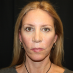 Facelift Before & After Patient #23556