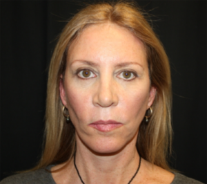 Facelift Before & After Patient #23556