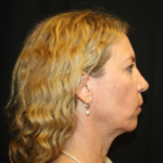 Facelift Before & After Patient #23556