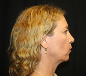 Facelift Before & After Patient #23556