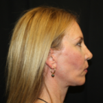 Facelift Before & After Patient #23556