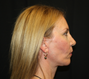 Facelift Before & After Patient #23556