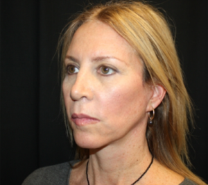 Facelift Before & After Patient #23556