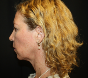 Facelift Before & After Patient #23556