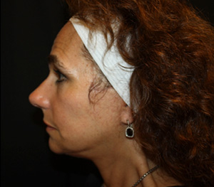 Facelift Before & After Patient #23478