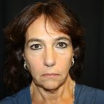 Facelift Before & After Patient #23478