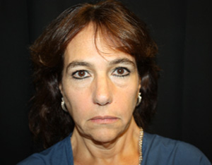 Facelift Before & After Patient #23478