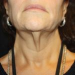 Facelift Before & After Patient #23478