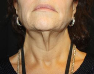 Facelift Before & After Patient #23478