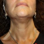 Facelift Before & After Patient #23478