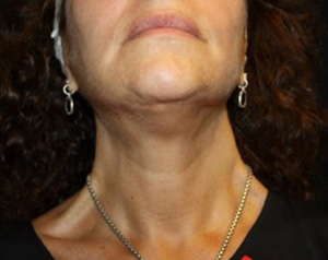 Facelift Before & After Patient #23478