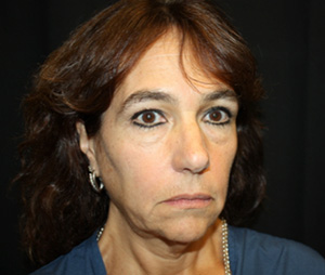 Facelift Before & After Patient #23478