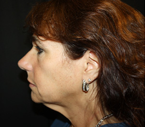 Facelift Before & After Patient #23478