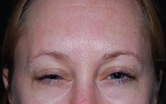 Botox and Dysport Before & After Patient #24781