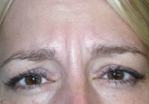 Botox and Dysport Before & After Patient #24788