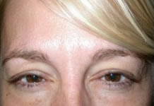 Botox and Dysport Before & After Patient #24788