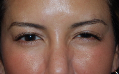 Botox and Dysport Before & After Patient #24807