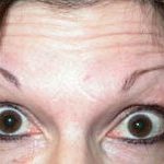 Botox and Dysport Before & After Patient #24808