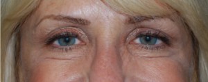 Botox and Dysport Before & After Patient #24816