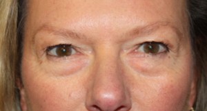 Blepharoplasty Before & After Patient #24989