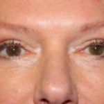 Blepharoplasty Before & After Patient #24989