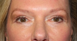 Blepharoplasty Before & After Patient #24989