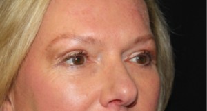Blepharoplasty Before & After Patient #24989