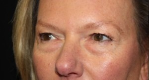 Blepharoplasty Before & After Patient #24989