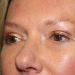 Blepharoplasty Before & After Patient #24989