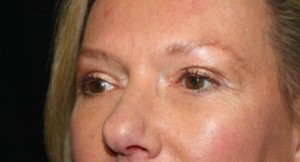 Blepharoplasty Before & After Patient #24989