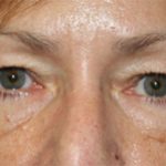 Blepharoplasty Before & After Patient #25007